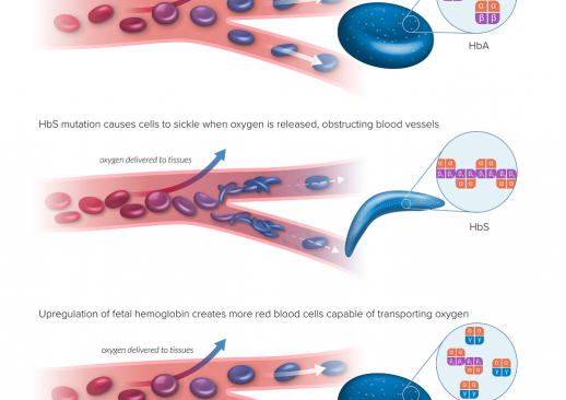 Fulcrum-Illustration-Sickle-Cell